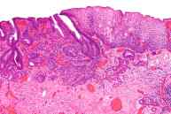 adenocarcinoma de esofago