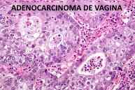 adenocarcinoma de vagina