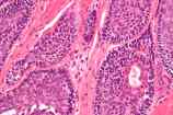 adenoma de celulas basales