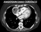 angiosarcoma cardiaco