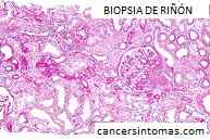biopsia de riñon