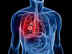 Sintomas do câncer de pulmão