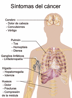 síntomas de cáncer