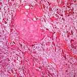 cancer de celulas escamosas de la vesicula biliar
