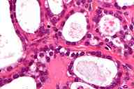 cancer de ovario epitelial de celulas claras