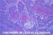 cancer vaginal de celulas escamosas