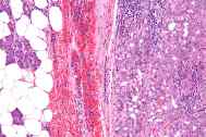 carcinoma de celulas acinares