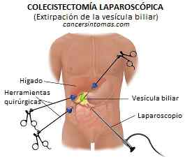 colecistectomia laparoscopica