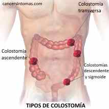 colostomia