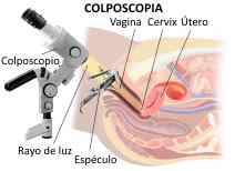 colposcopia