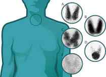 gammagrafia de tiroides