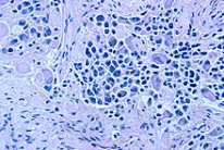 Células de neuroblastoma