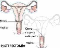 histerectomia