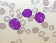 leucemia linfocitica aguda
