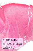 neoplasia intraepitelial vaginal