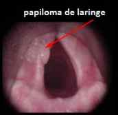 papiloma de laringe