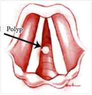 polipo en las cuerdas vocales