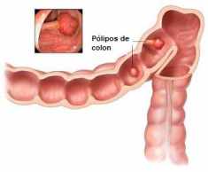 Simptomele cancerului de colon drept - ELYTIS Hospital
