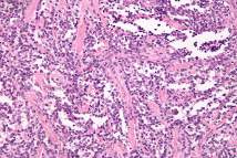 rabdomiosarcoma alveolar