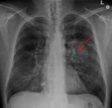 radiografia de un cancer de pulmon