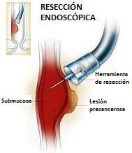 reseccion endoscopica