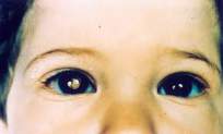 Reflexo branco típico do retinoblastoma.