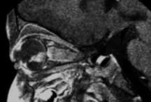 Neuroblastoma en resonancia magnética