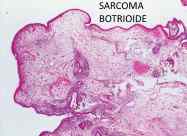 sarcoma botrioide
