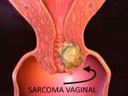 sarcoma vaginal