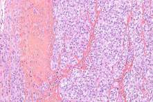 sarcoma de celulas claras