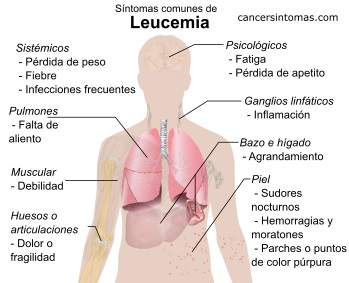 sintomas de leucemia