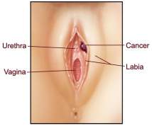 Sintomas de câncer vulvar