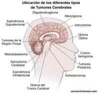 tipos de tumores cerebrales