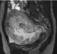 tomografia de un cancer de ovario