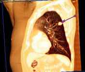 tomografia de un cancer de pulmon