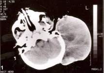 tomografia rabdomiosarcoma alveolar