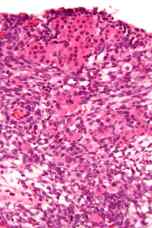 tumor de celulas de Sertoli-Leydig