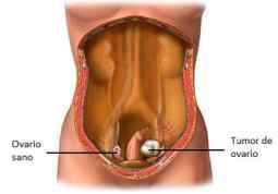 tumor de ovário