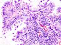 tumor de ovario borderline mucinoso